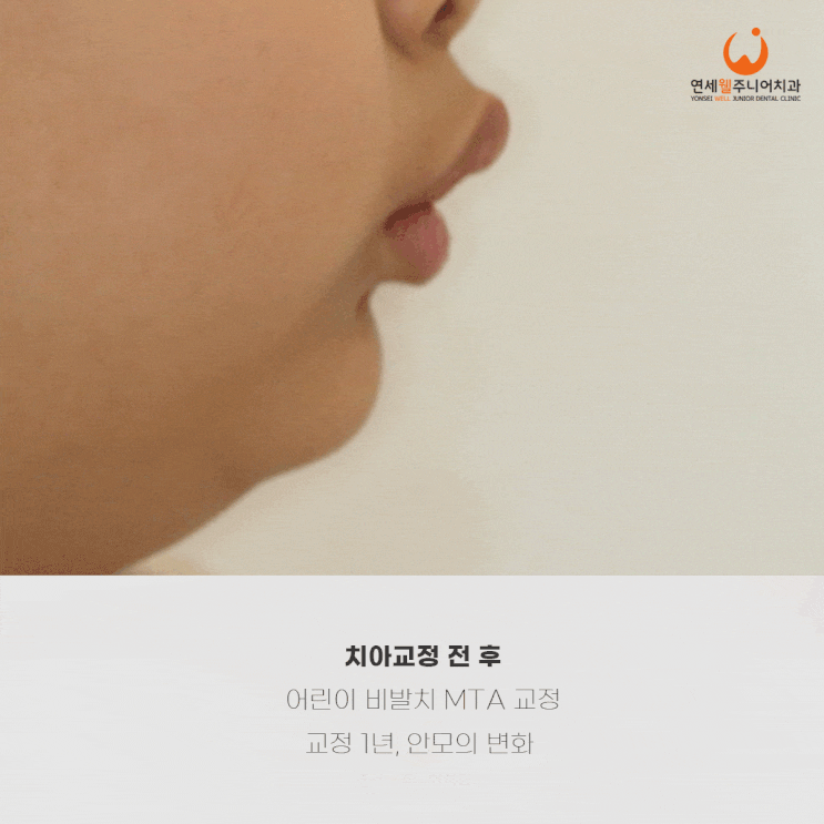 윗턱이 앞으로 발달해 입이 돌출되어 보이는 초등학생 옆모습