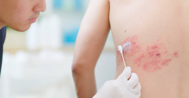 대상포진 증상&amp;#44; 전염&amp;#44; 치료방법 총정리 (2024ver)