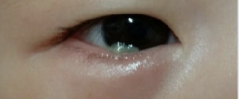 아기눈꼽감기