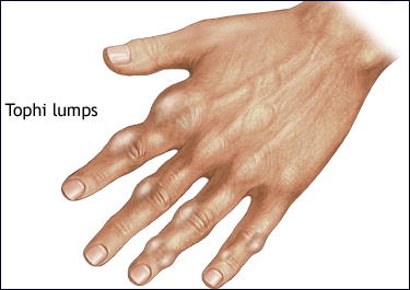 손가락에 생긴 토피 결정덩어리