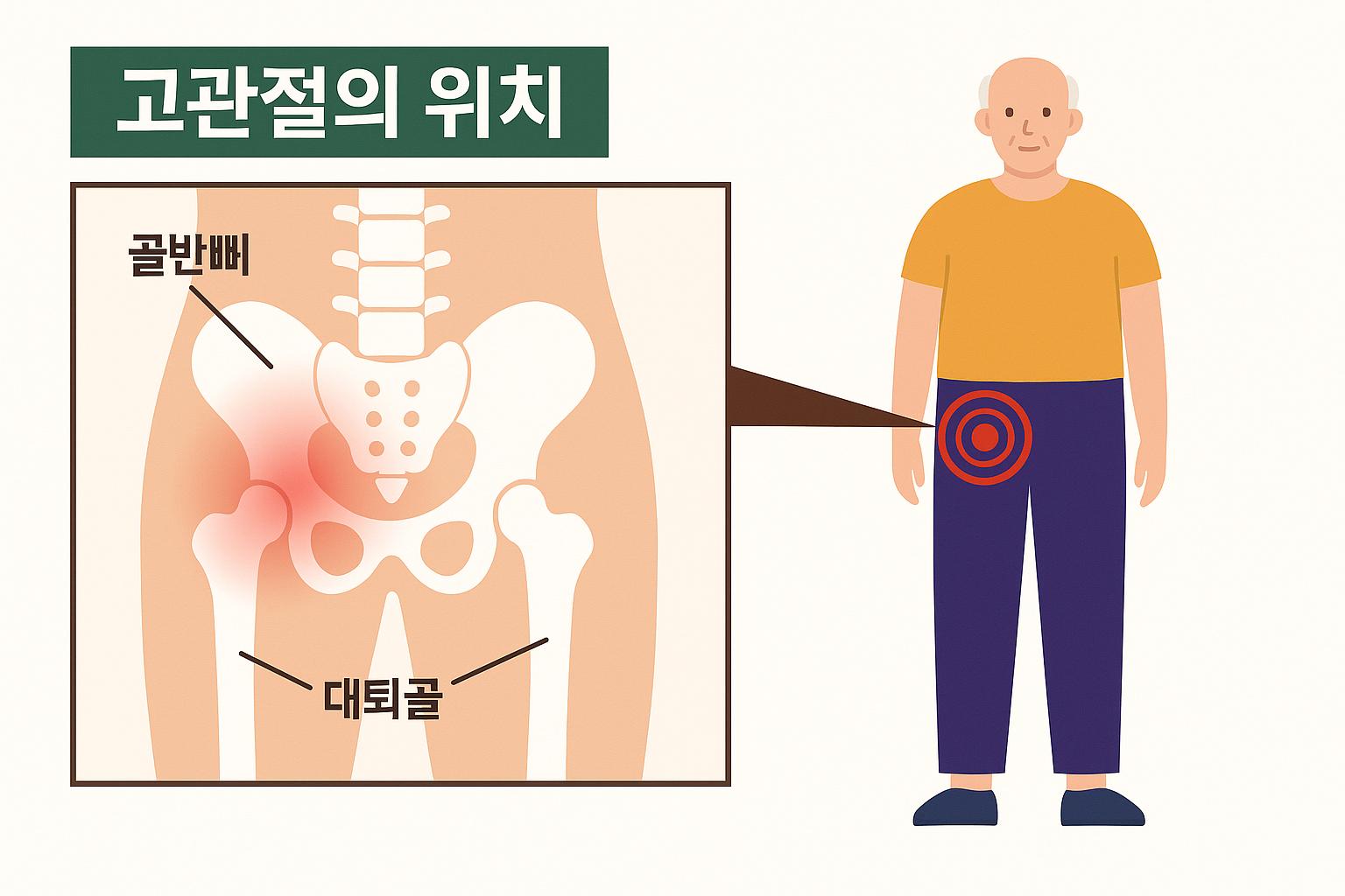 골반뼈와 대퇴골의 연결부위인 고관절 위치를 보여주는 만화체 그림