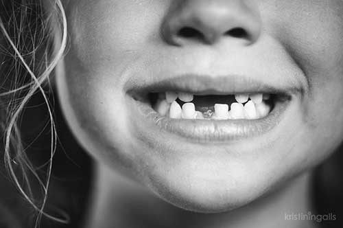 앞니 이빨 빠진 아이