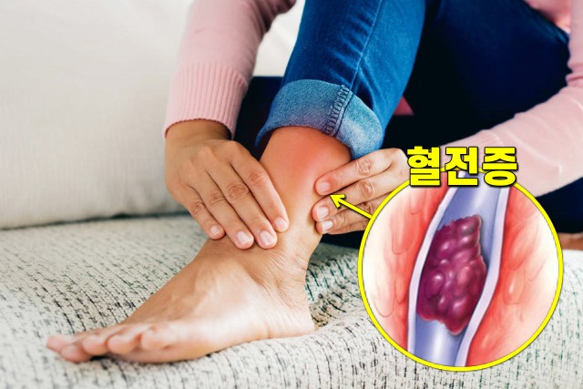 한쪽 발이 붓는 이유, 혈전증 정맥염 증상