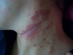 지루성 피부염 완치하려면