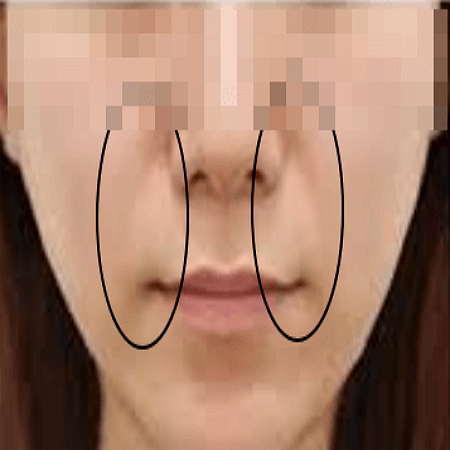 팔자주름 필러 맞기 전 사진