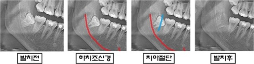 사랑니 발치 후 식사 가이드