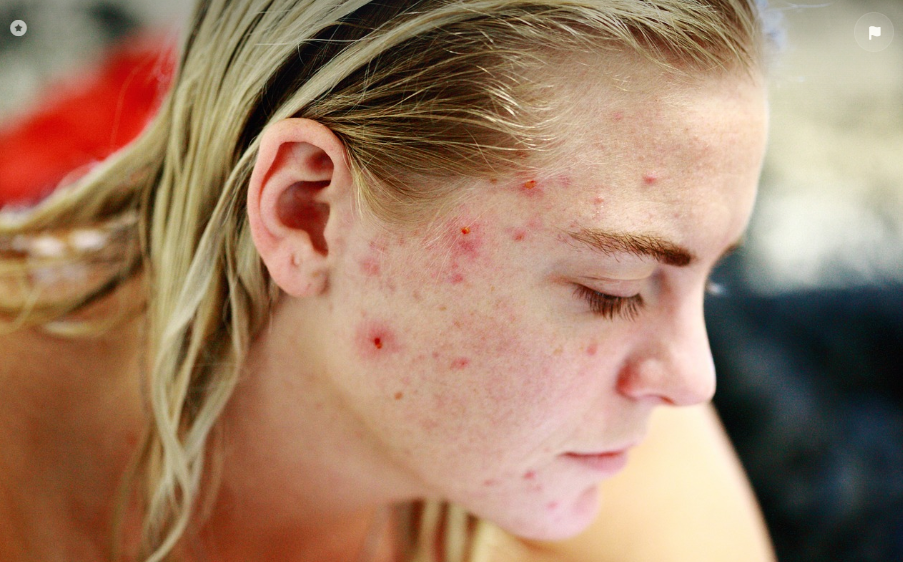 여드름 있는 얼굴