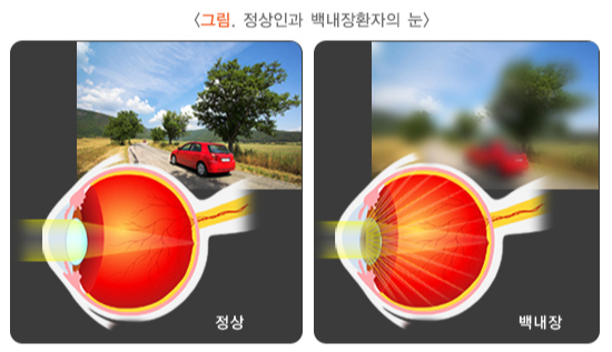 정상과 백내장 환자의 눈