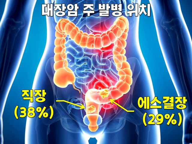 대장암 초기증상, 변비 설사 1주일, 대장암 증상, 건강 팁줌 매일꿀정보