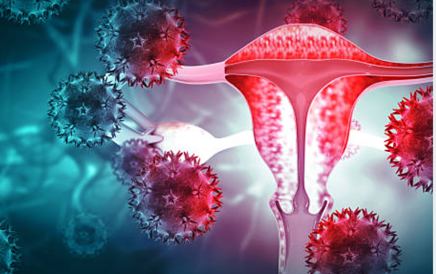 자궁암과 관련된 사진