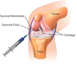 관절에 좋은 영양제 추천