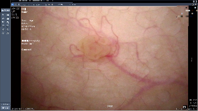 방광암 경요도절제술 내시경 사진