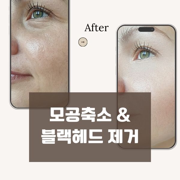 모공축소 &블랙헤드 제거