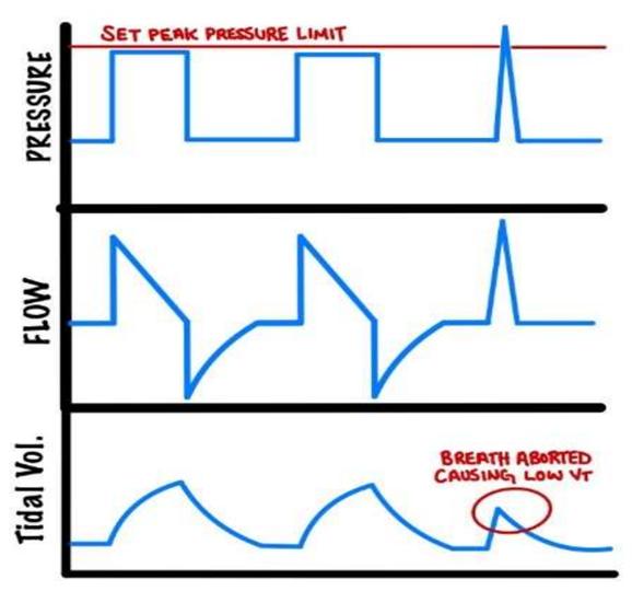 peak pressure apnea
