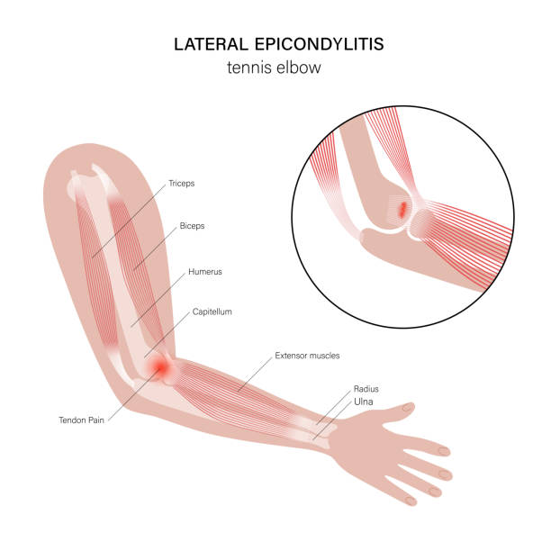 테니스 엘보우 엘보 치료 위치 보호대 원인 를 치료하려면 외측상과염 수술 스트레칭 운동 mri 체외충격파 골프 팔꿈치 근력 재활 염증 냉찜질