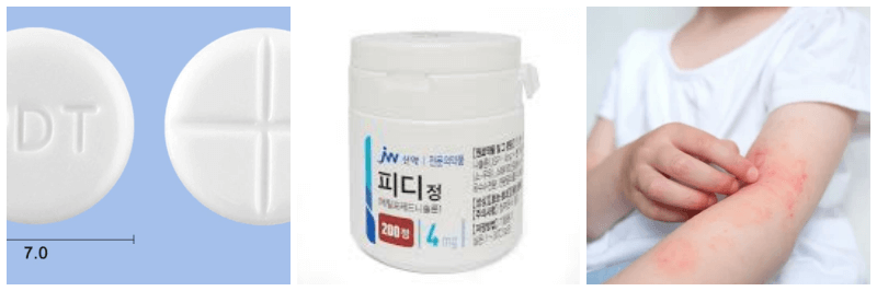 피디정, 피부염 사진