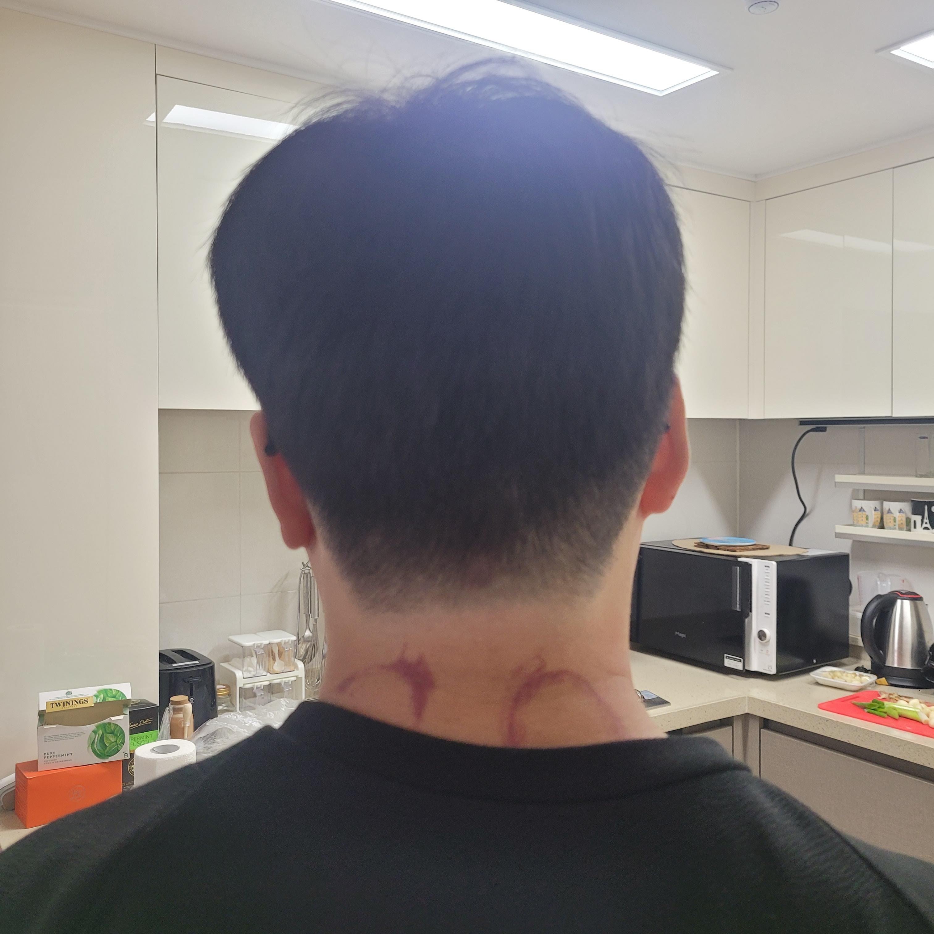 목디스크-물리치료-도수치료