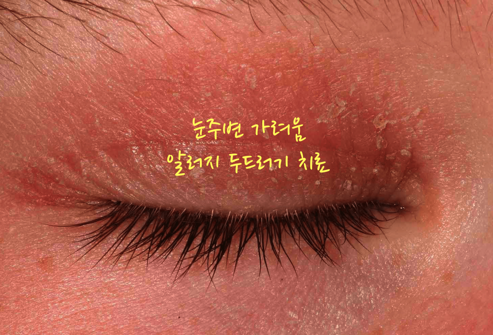 눈주변 가려움