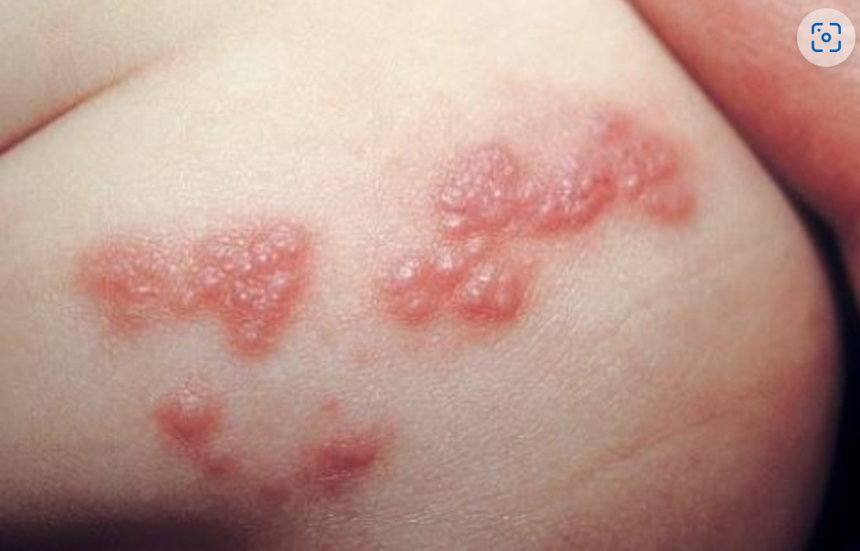 신경 따라 퍼지는 통증 양상