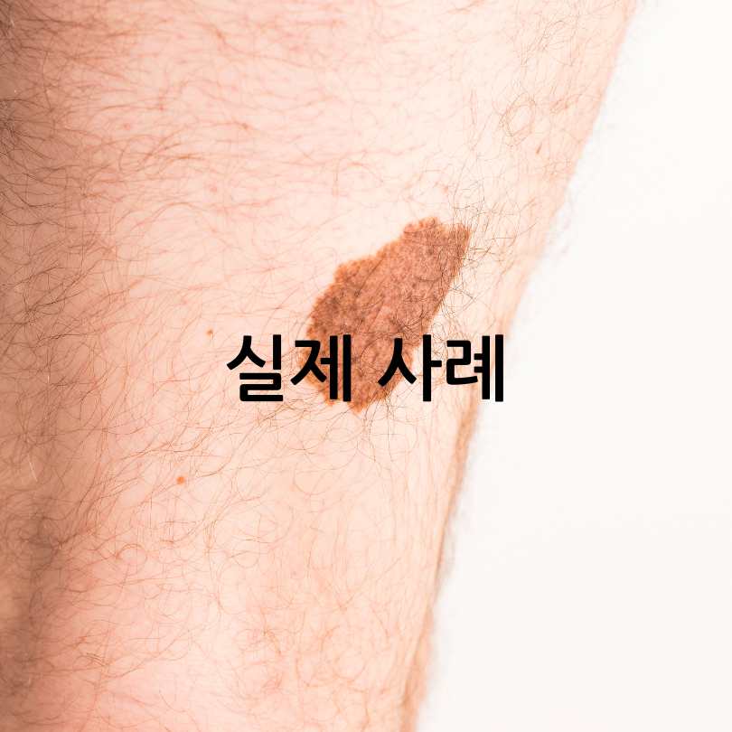 피부암 자가진단법&amp;#44; 피부암 점모양과 초기증상