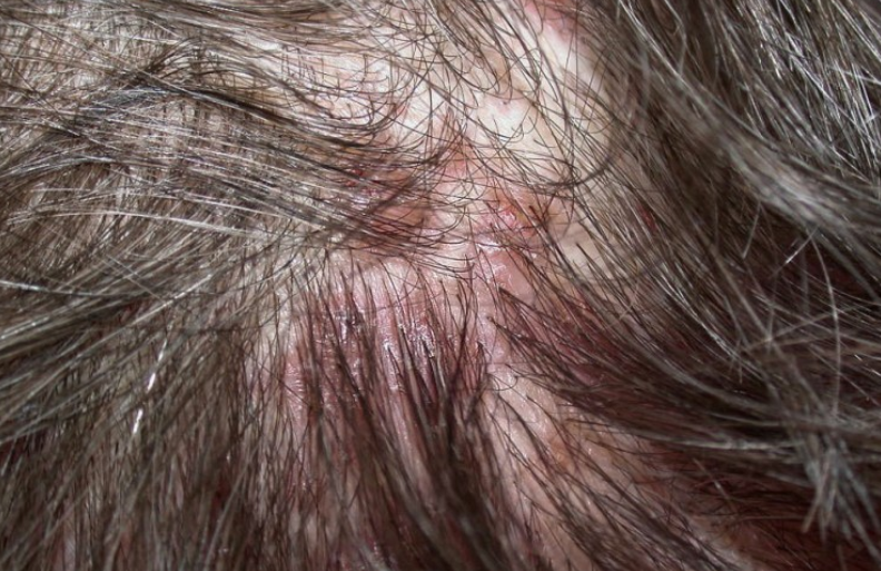 두피 모낭염