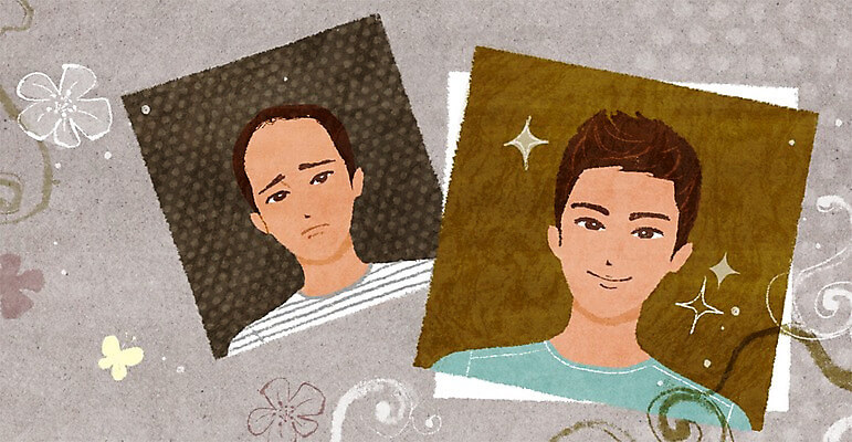 모발이식 부위별 비용