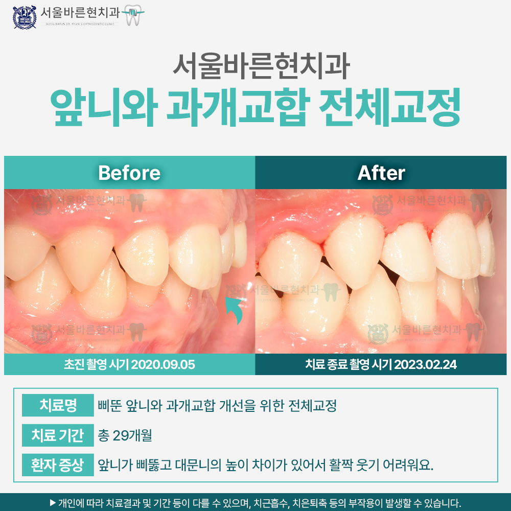 해운대치아교정