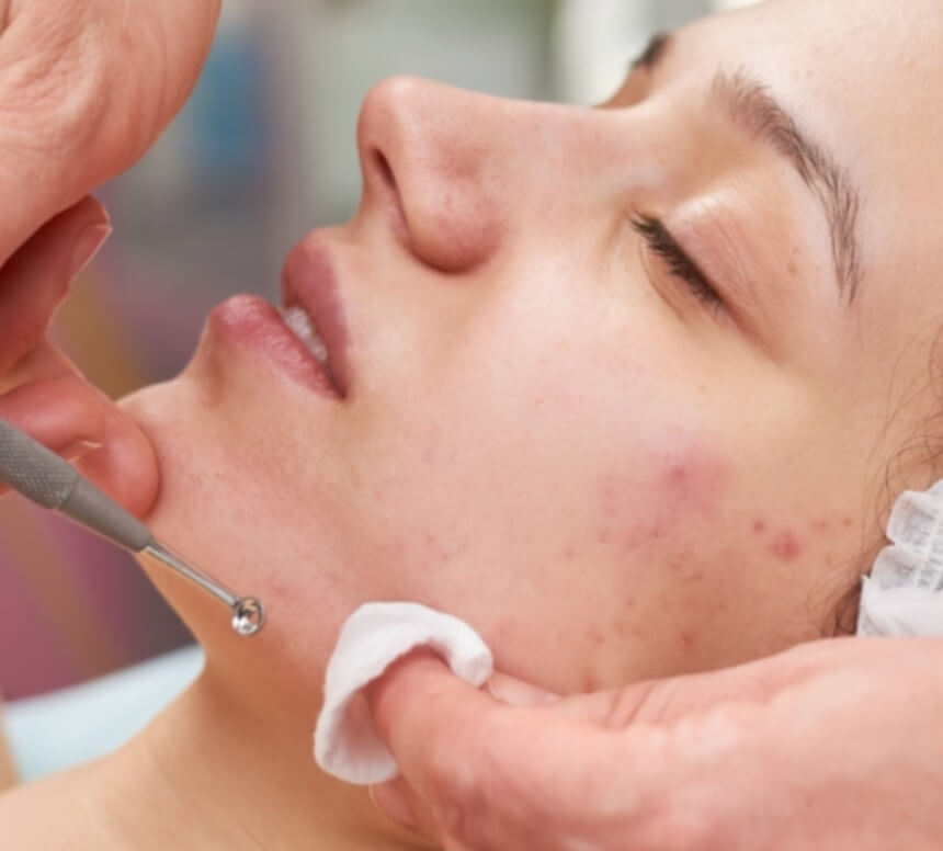 모고 피지 제거 모습