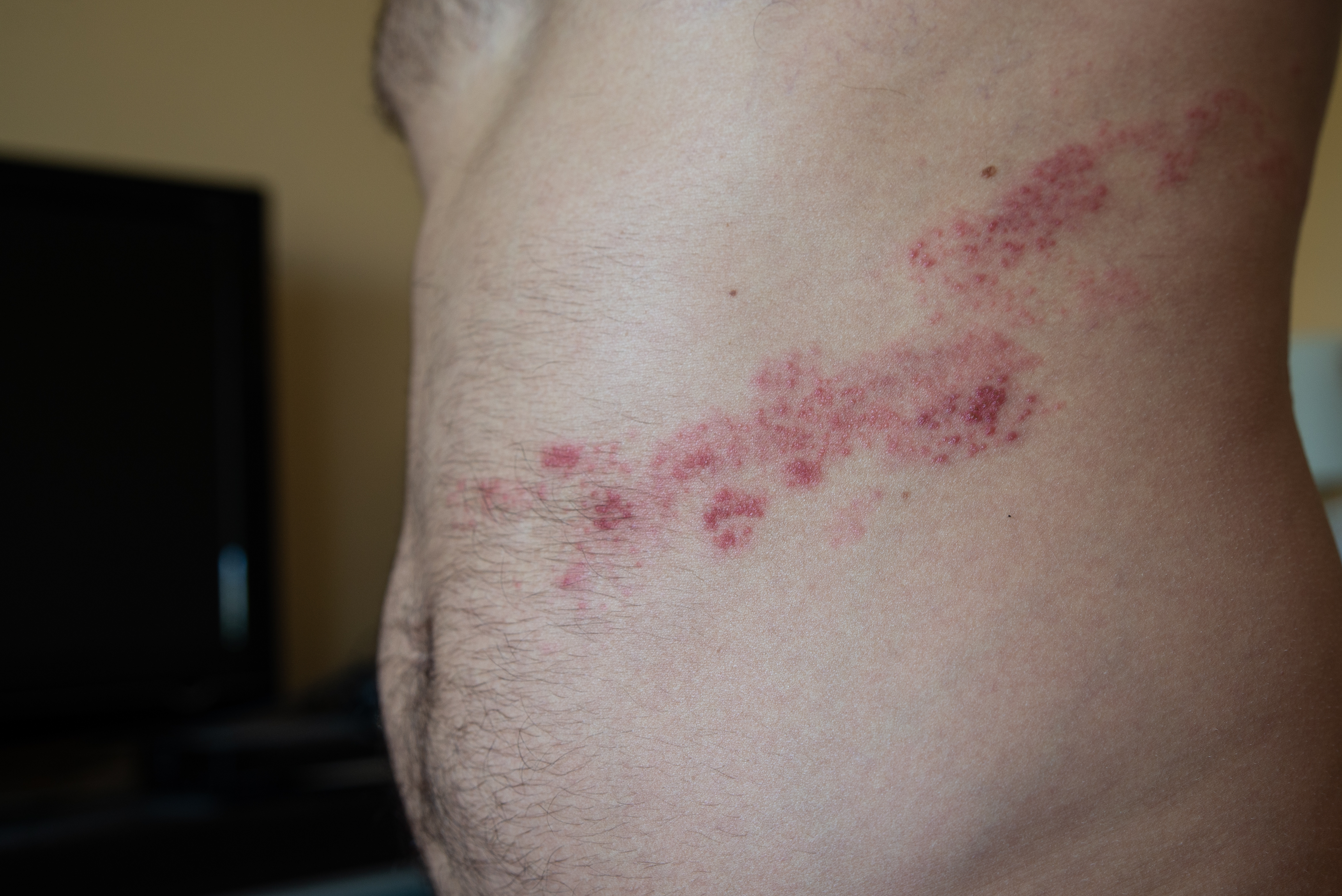 대상 포진 수포