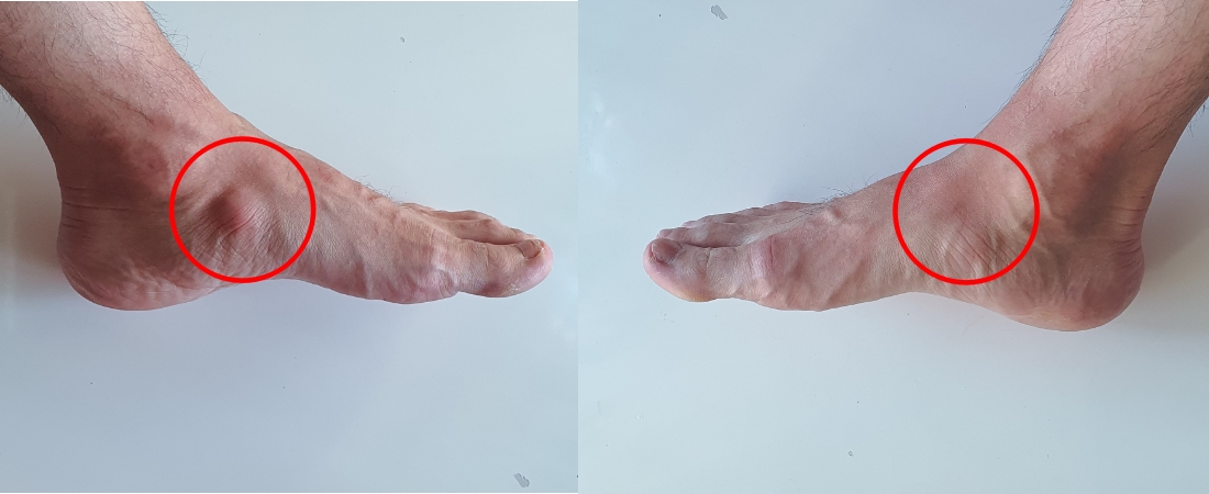 부주상골증후군_치료_후_상태