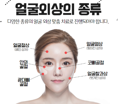 광대뼈 골절의 치료 과정