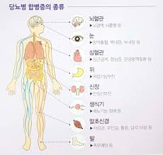 당뇨병