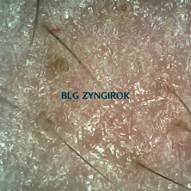 탈모 극복 프로젝트 - 오른쪽 M자 부위 두피 모습이다.