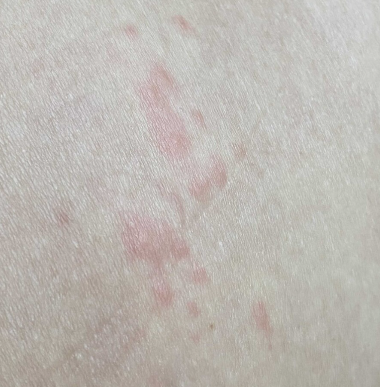대상포진