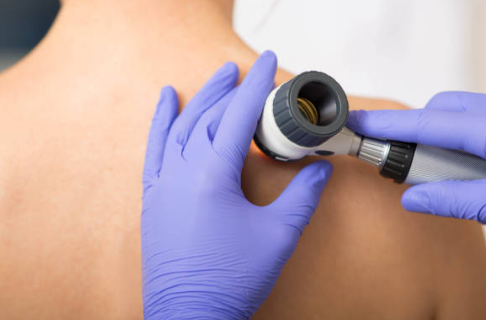 쥐젖 제거방법, 쥐젖이 생기는 이유, 제거 연고 총정리 (2024ver)