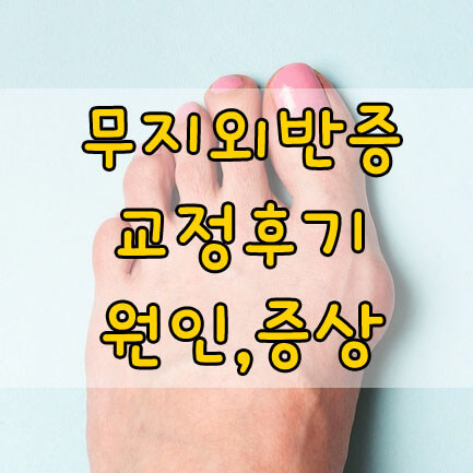 무지외반증 교정기 후기, 원인, 치료법, 운동법 총정리!