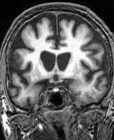 헌팅턴병 원인 증상 치료법