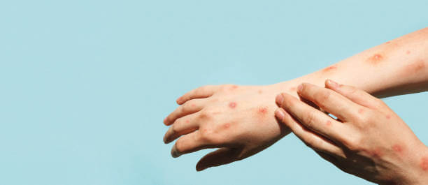 엠폭스 피부 발진 사진