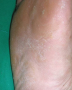 무좀 증상별 무좀약 추천