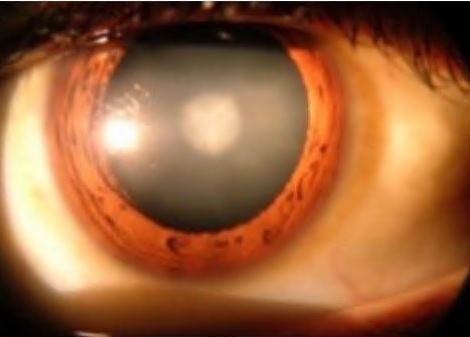 백내장-수술비용-가격