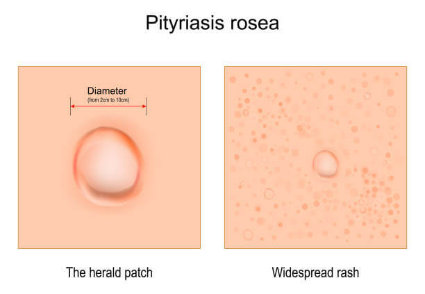 장미색 비강진 원인, 치료, 재발 등에 대해 알아봤습니다. 장미색 비강진은 pityriasis rosea이라고 불리는데요. 어떤 증상과 원인 치료가 있는지 꼼꼼히 읽어보세요!