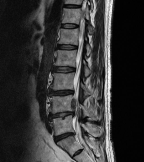 허리디스크 증상