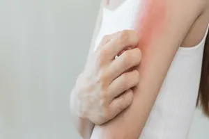 두드러기-원인