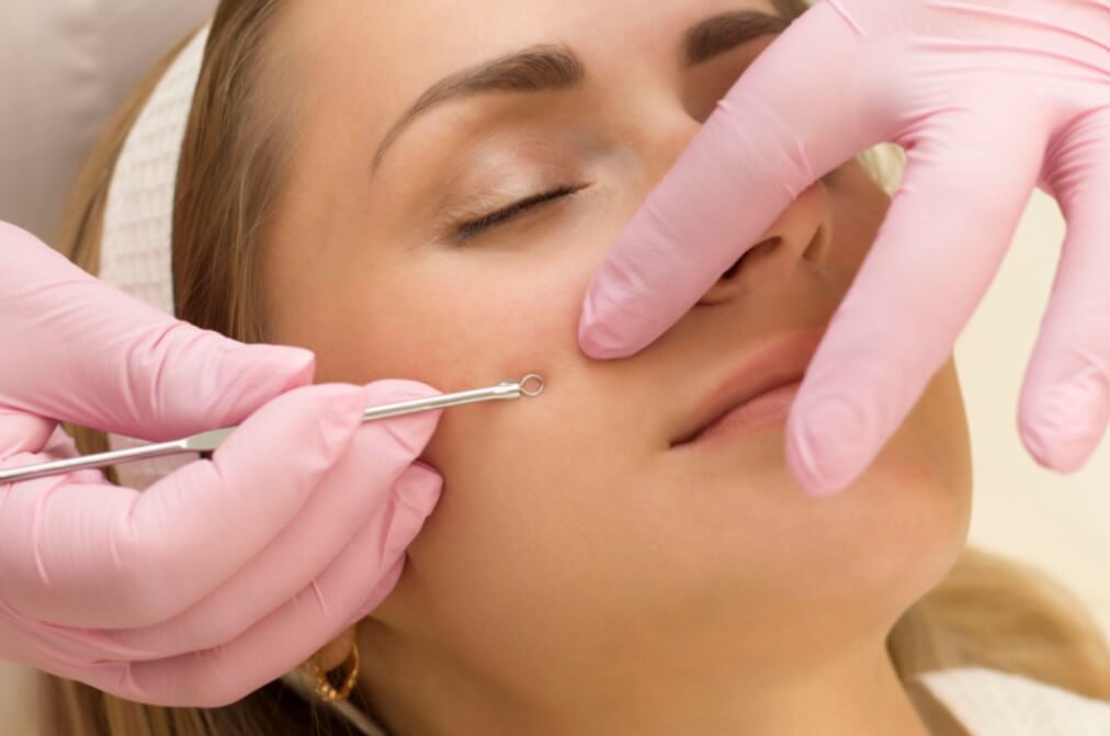 모고 피지 제거 모습