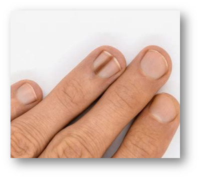 손톱 검은 세로줄4