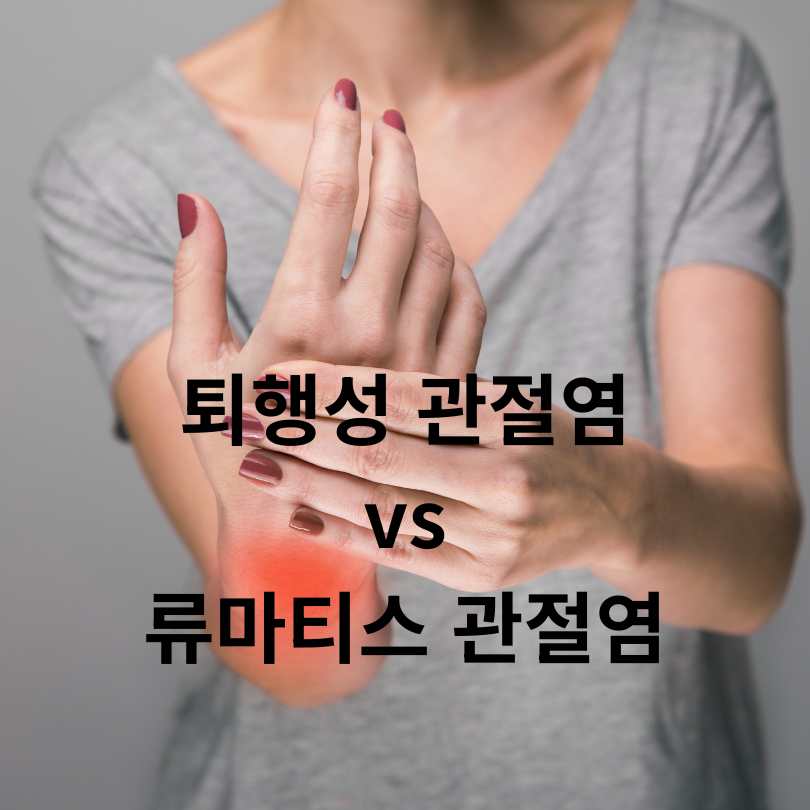 퇴행성 관절염과 류마티스 관절염의 차이점