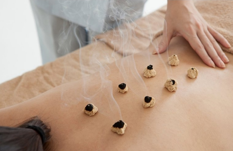 젊은 여성이 한의원 침대에 상의를 탈의하고 엎드려 있고, 한의사가 허리와 등쪽에 쑥뜸을 뜨고 있는 것을 찍은 사진