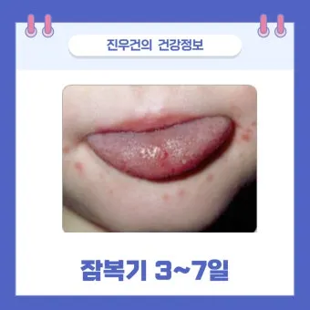 수족구 어른 전염에 대한 원인과 예방법 정리_5
