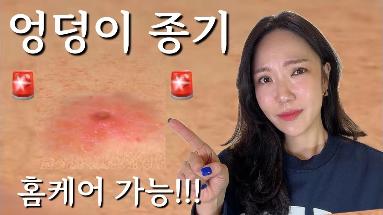 엉덩이 종기가 생기는 이유 왜 생기고 어떻게 관리할까요 완벽 가이드_5