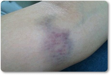 혈소판 수치가 높으면